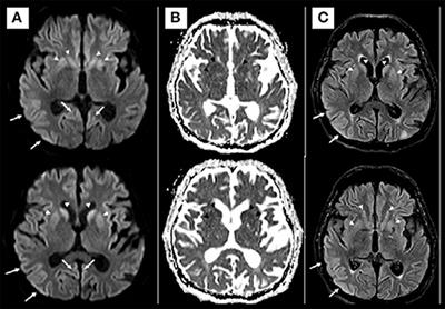 Case Report: Neurodegenerative Diseases After Severe Acute Respiratory Syndrome Coronavirus 2 Infection, a Report of Three Cases: Creutzfeldt–Jakob Disease, Rapidly Progressive Alzheimer's Disease, and Frontotemporal Dementia